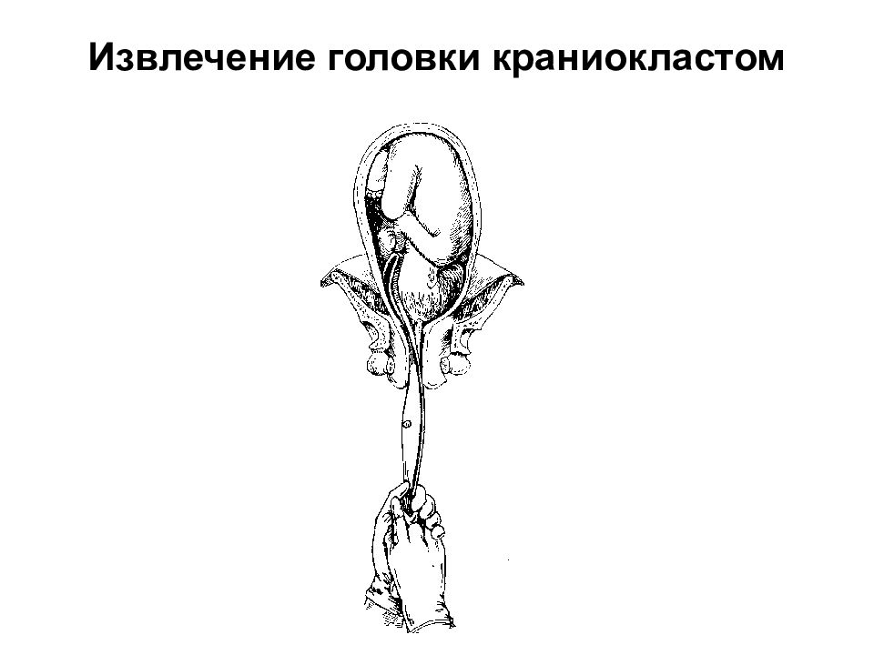 Выполнение перинеотомии эпизиотомии. Акушерские операции презентация. Декапитационный крючок операция. Виды акушерских операций.