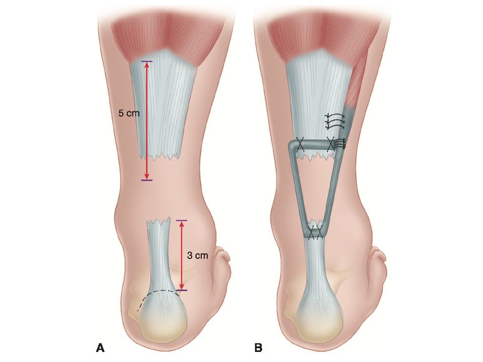 Ахиллово сухожилие. Пластика ахиллово сухожилие. Ахиллово сухожилие разрыв операция. Операция шов ахиллова сухожилия. Операция на ахиллова сухожилия пластика.
