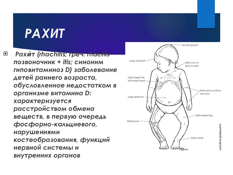 Рахит у детей презентация педиатрия