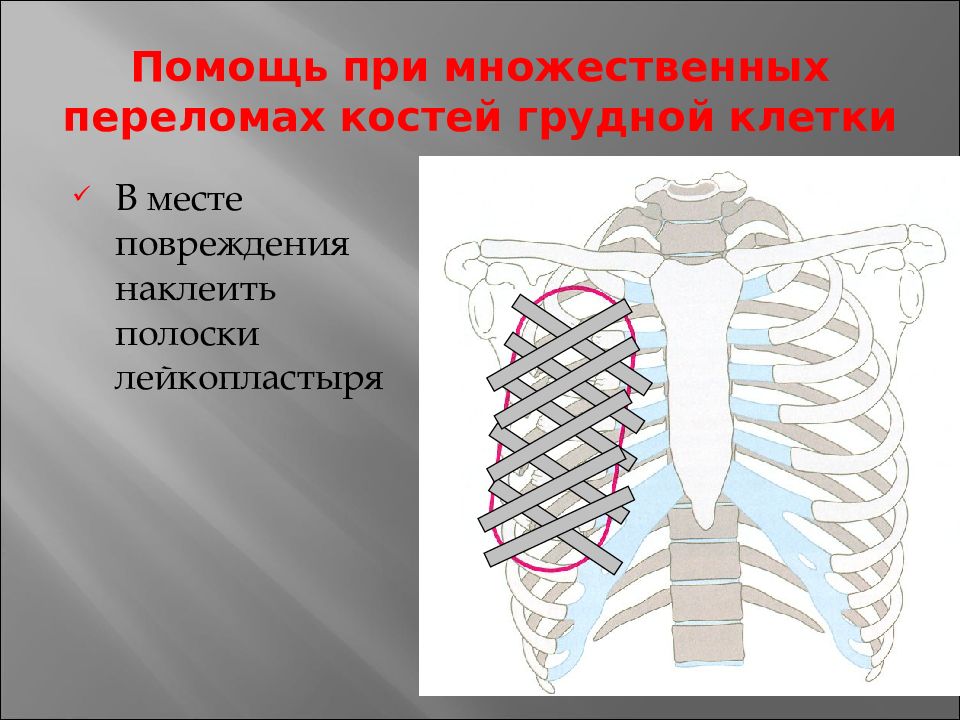 Перелом грудной клетки. При переломе ребер необходимо. Перелом костей грудной клетки.