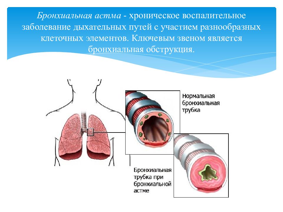 Патологии дыхательных путей. Заболевания дыхательных путей. Инфекции верхних дыхательных путей. Воспаление дыхательных путей. Воспалительные заболевания верхних дыхательных путей.