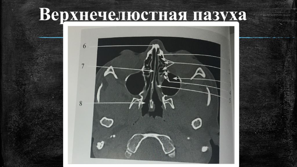 Стенки основной пазухи анатомия кт