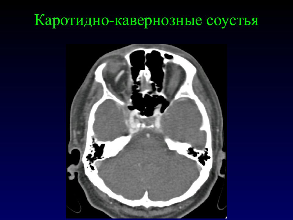 Тромбоз кавернозного. Тромбоз пещеристого синуса клиника. Каротидно-кавернозное соустье и тромбоз. Кавернозно каротидное соустье. Тромбоз кавернозного синуса на кт.