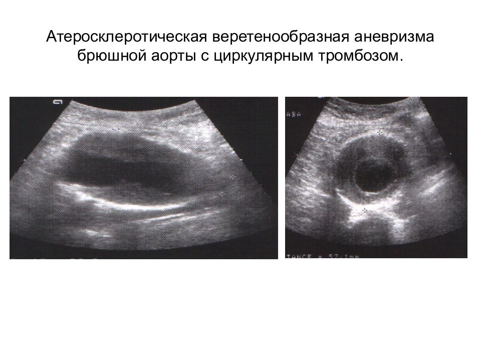 Узи брюшной аорты. Расслаивающая аневризма аорты УЗИ. Эхограмма брюшной аорты с тромбом. Расслоение аневризмы аорты УЗИ. Аневризма брюшного отдела аорты на УЗИ.