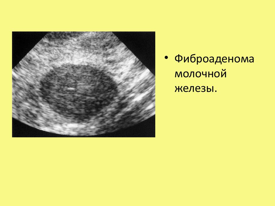 Фиброаденома молочной железы презентация