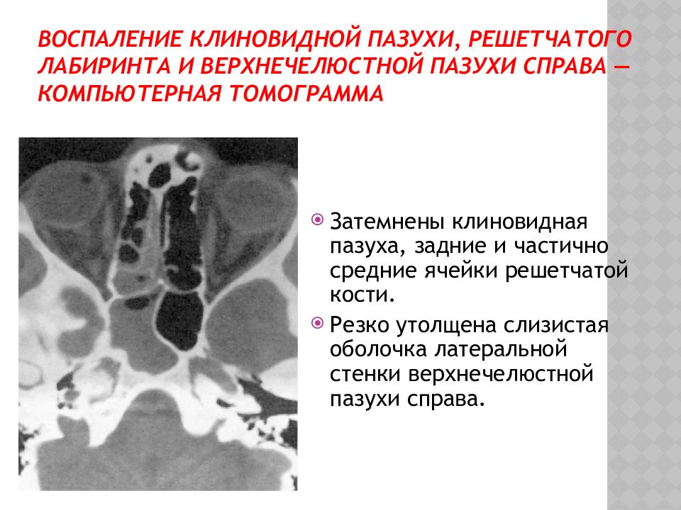 Острые и хронические синуситы презентация