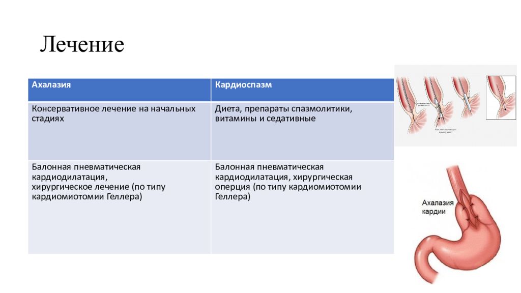 Кардия желудка 2 степени. Кардиоспазм ахалазия кардии и эзофагоспазм. Пилороспазм ахалазия кардии. Ахалазия кардии и кардиоспазм. Классификация ахалазии кардии.