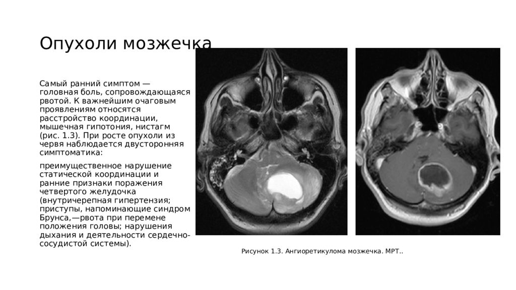 Объемное образование. Клинические проявления опухоли мозжечка:. Объемное образование правой гемисферы мозжечка что это. Опухоль червя мозжечка.