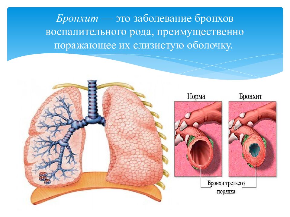 Заболевание бронхов