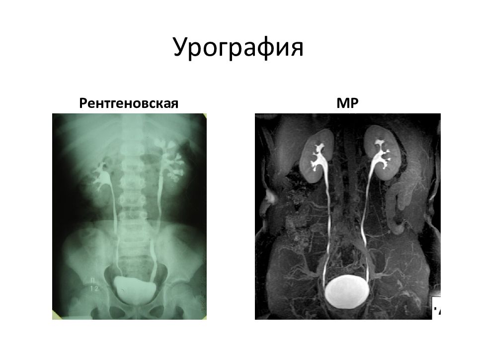 Урография. Магнитно-резонансная урография. Компьютерная урография.