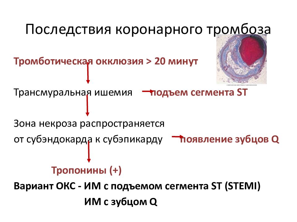 Острый инфаркт миокарда клиническая картина