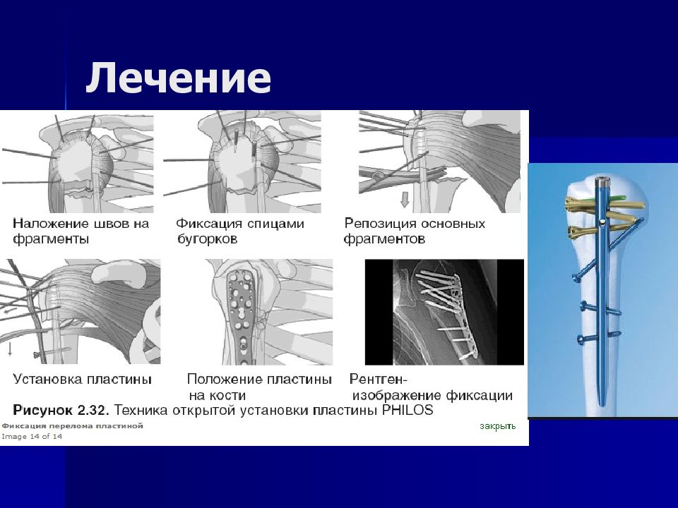 Фиксирует изображение. Трансартикулярная фиксация спицей. Пластины защитные для рентгена. Шов который фиксирует спицу.