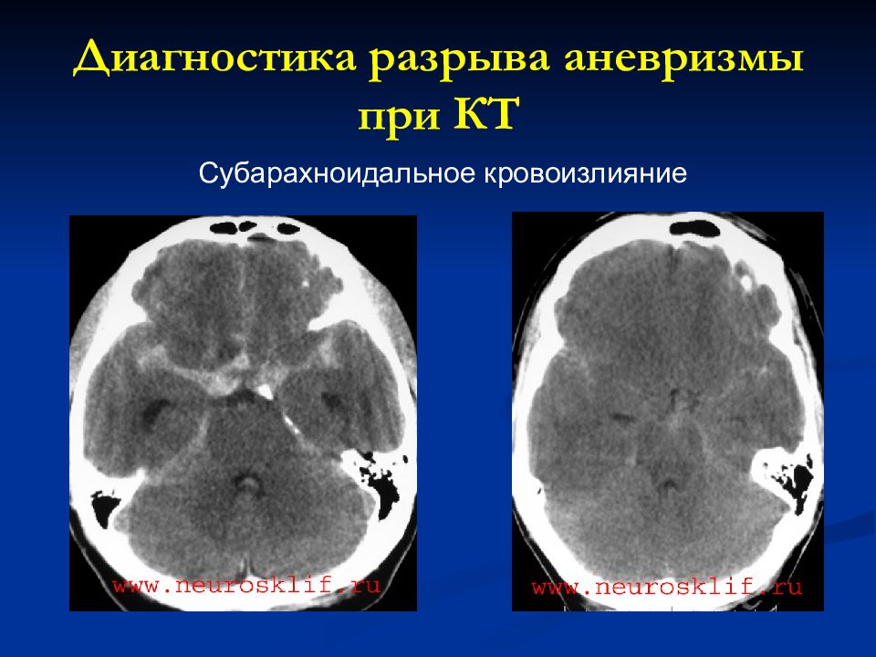 Код мкб субарахноидальное кровоизлияние. Код мкб субарахноидальное кровоизлияние. Код мкб субарахноидальное кровоизлияние. Код медицинского стандарта. Ушиб головного мозга мк.