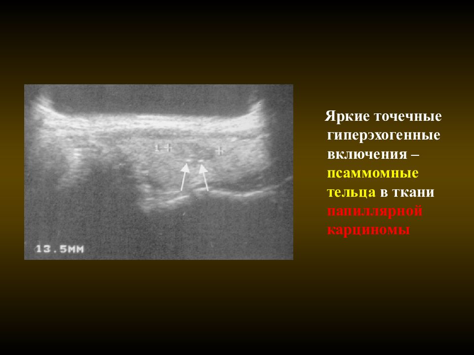 Синус гиперэхогенный. Гиперэхогенные точечные включения. Псаммомные тельца щитовидной железы. Гиперэхогенные включения в щитовидке это. Киста с гиперэхогенными включениями.