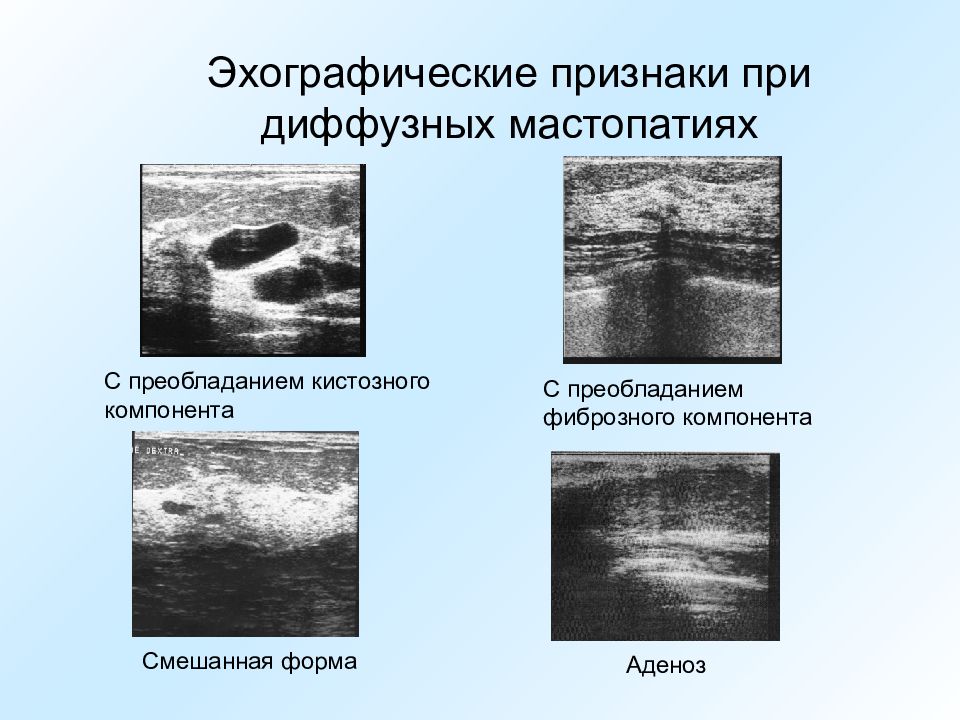 Рисунок изменен по типу фиброаденоматоза с преобладанием фиброзного компонента