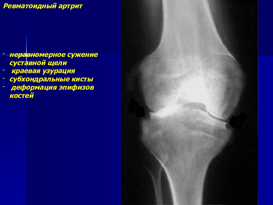 Склероз суставных поверхностей. Эпифиз большеберцовой кости рентген кисты. Субхондральных отделов эпифизов. Неравномерная суставная щель.