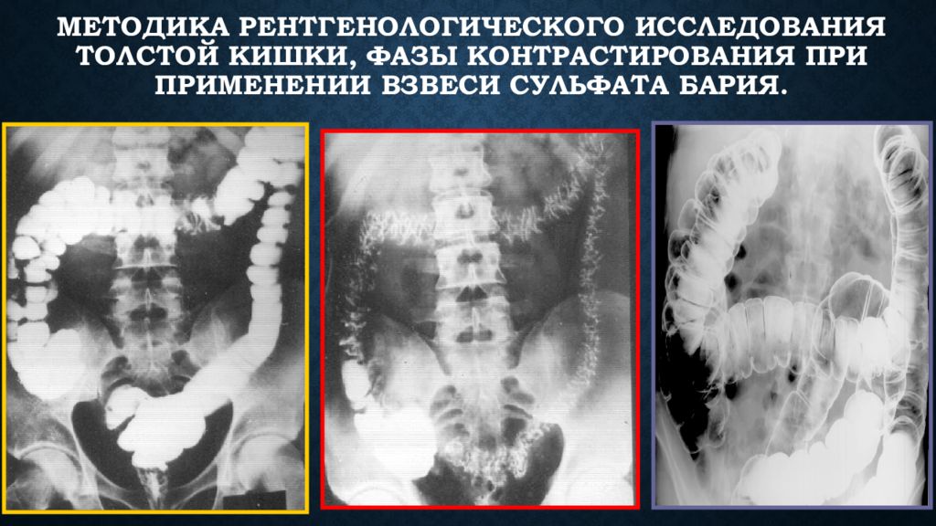 Рентгеноконтрастный барий. Ирригоскопия Толстого кишечника рентген. Кишечная непроходимость ирригоскопия. Пассаж барием Толстого кишечника. Непроходимость Толстого кишечника рентген.