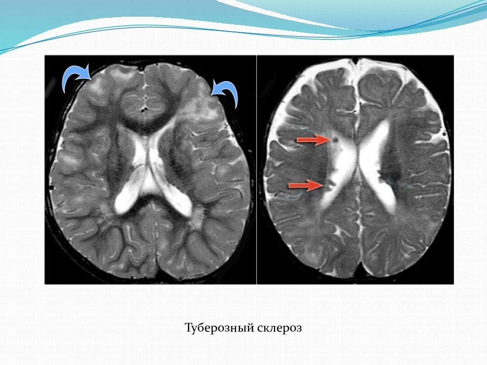 Туберозный склероз. Туберозный склероз почек кт. Туберозный склероз почек на УЗИ. Туберозный склероз презентация. Туберозный склероз почек мрт.