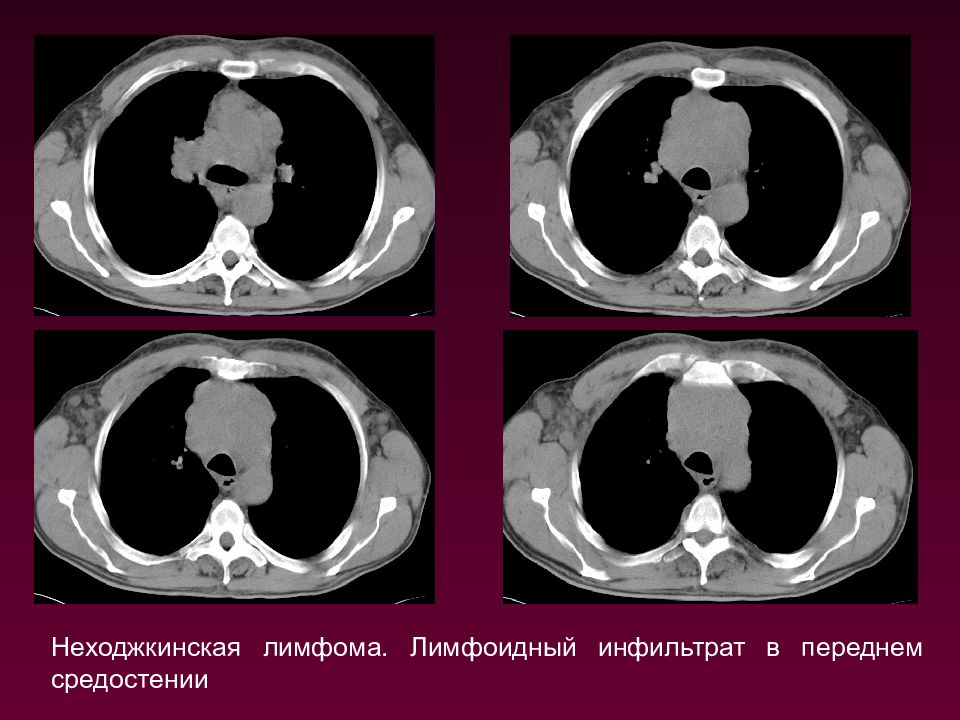 Неходжкинская лимфома. Неходжкинская лимфома средостения кт. Лимфома средостения на кт. Неходжкинские лимфомы кт.