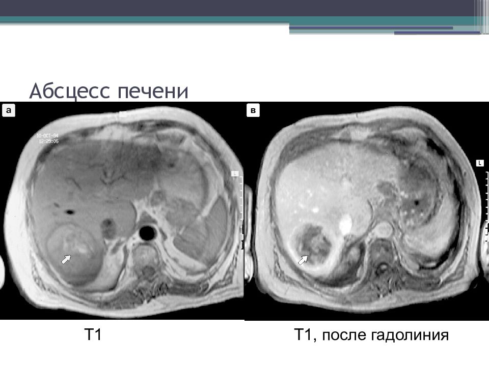 Признаки абсцесса печени на т1 взвешенных изображениях