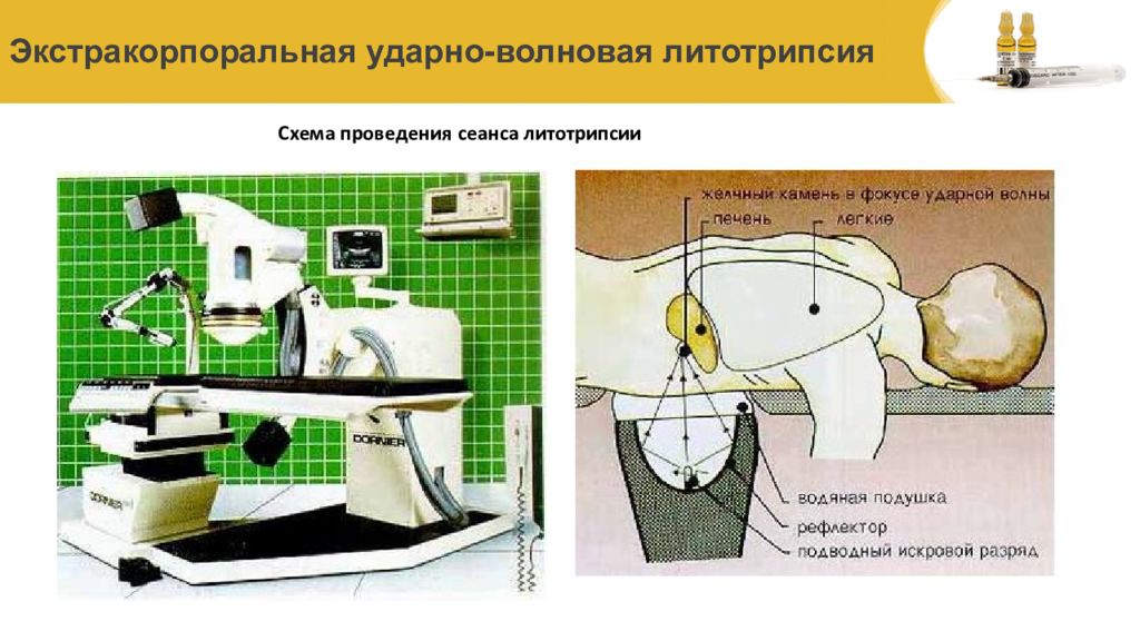 Литотрипсия камней в желчном пузыре