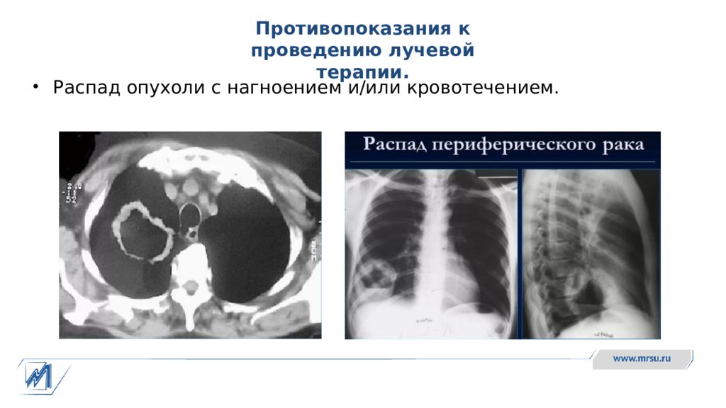 Показания и противопоказания к проведению лучевой терапии презентация