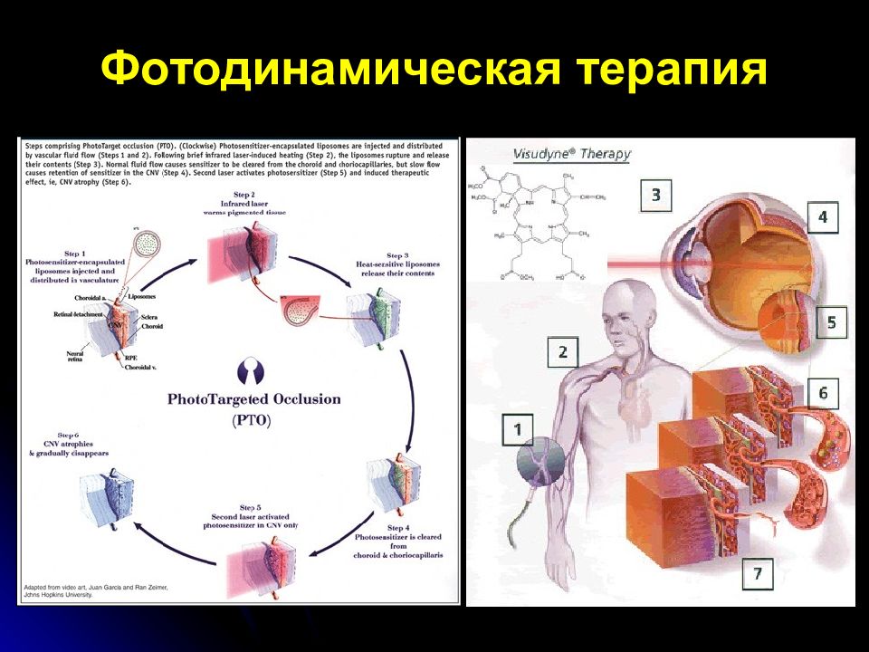 Фотодинамическая терапия отзывы форум. Фотодинамическая терапия (фдт). Фотодинамическая терапия (фдт). Аткус 2 фотодинамическая терапия. Фотодинамическая терапия (фдт).