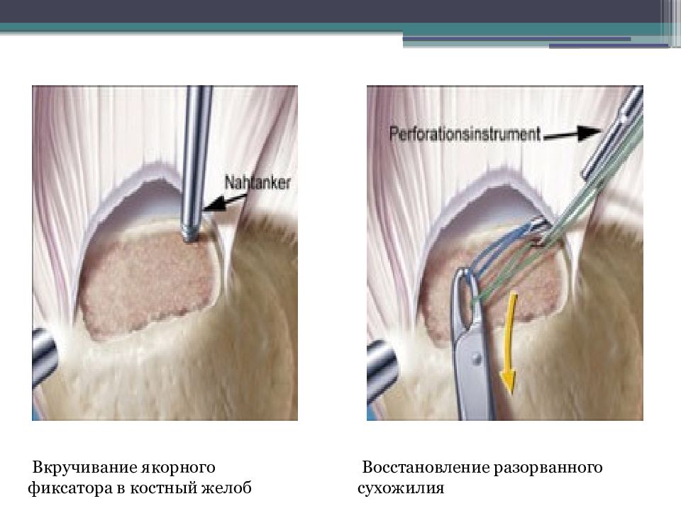 Восстановления разрывов. Якорный фиксатор сухожилия. Якорная фиксация ротаторной манжеты. Повреждение вращательной манжеты презентация. Якорные фиксаторы операции.