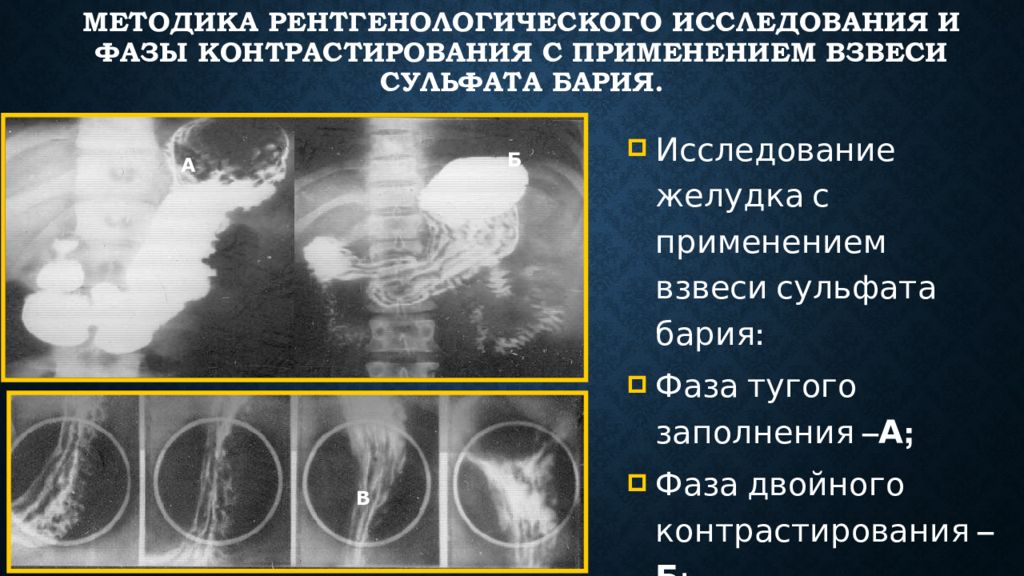 После бария. Фаза двойного контрастирования желудка. Фазы исследования желудка. Методики рентгенологического исследования желудка. Рентгенография метод исследования.