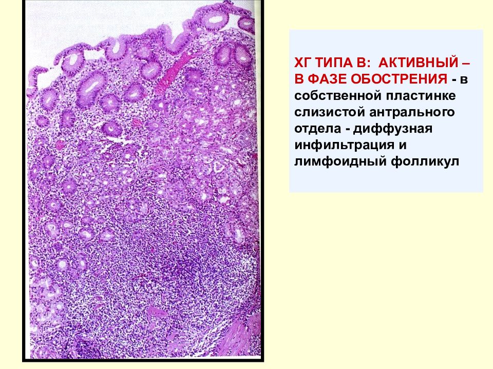 Лимфоидные фолликулы. Лимфоидный фолликул гистология кишечника. Лимфоидные фолликулы в собственной пластинке слизистой оболочки. Лимфоидные фолликулы в желудке гистология. Лимфофолликулярная гиперплазия слизистой оболочки желудка.