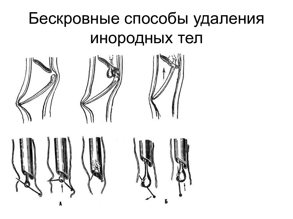 Удаление инородного. Способы удаления инородных тел. Удаление инородного тела операция. Удаление инородного тела пищевода.