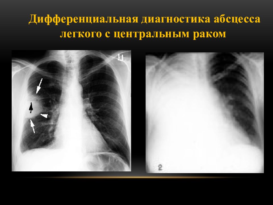 Лучевая диагностика рака легкого презентация