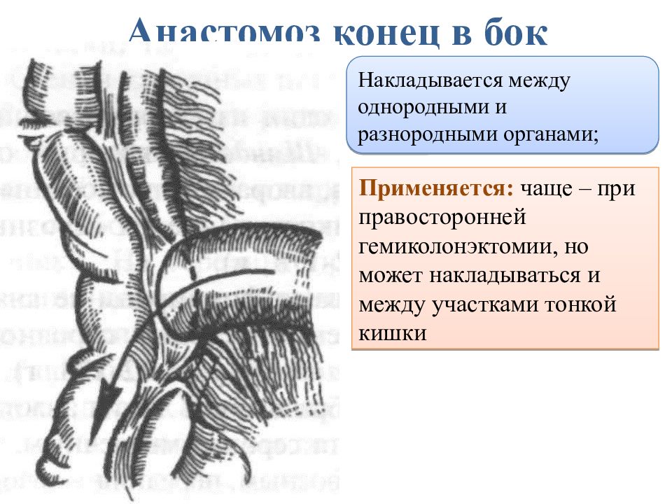 Кишечные анастомозы презентация