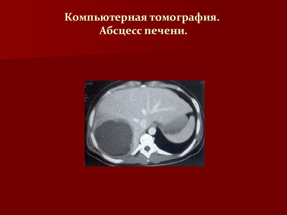 Абсцесс печени. Амебный абсцесс печени кт. Пиогенный абсцесс печени кт.