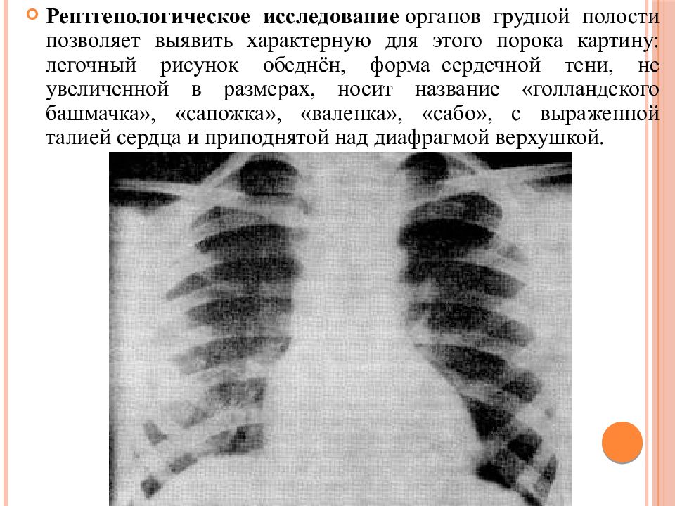 Сетчатая деформация легочного рисунка что это