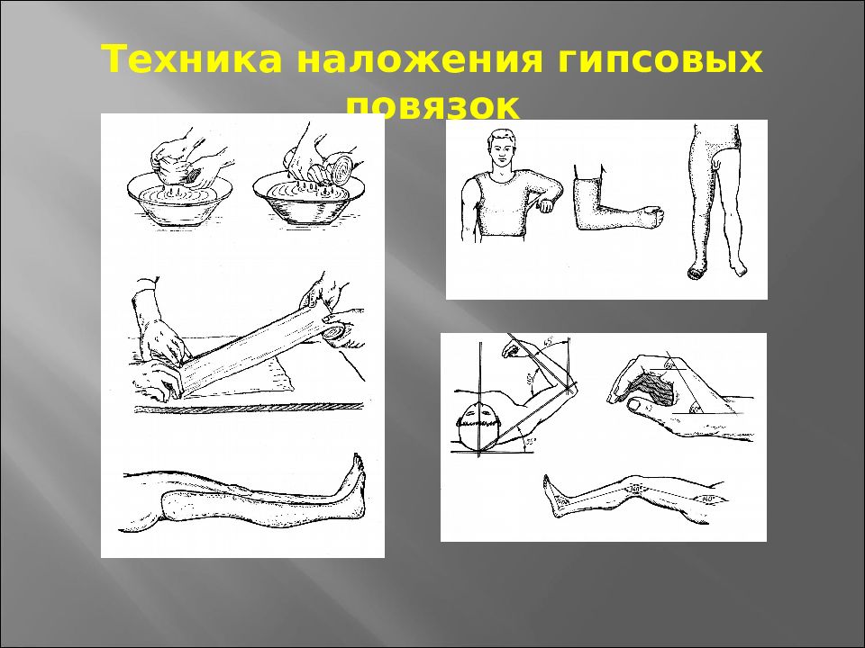 Наложение гипсовой лангеты. Техника наложения гипса. Наложение гипса алгоритм. Наложение гипсовой повязки. Техника наложения гипсовой повязки.