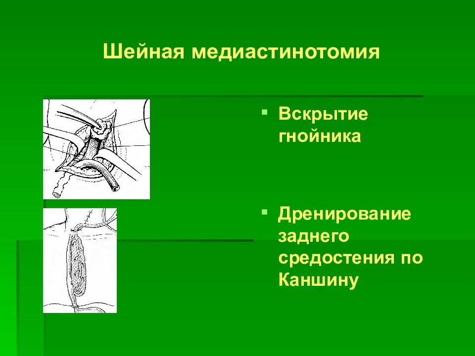 Гнойные заболевания глубоких клетчаточных пространств и железистых органов презентация