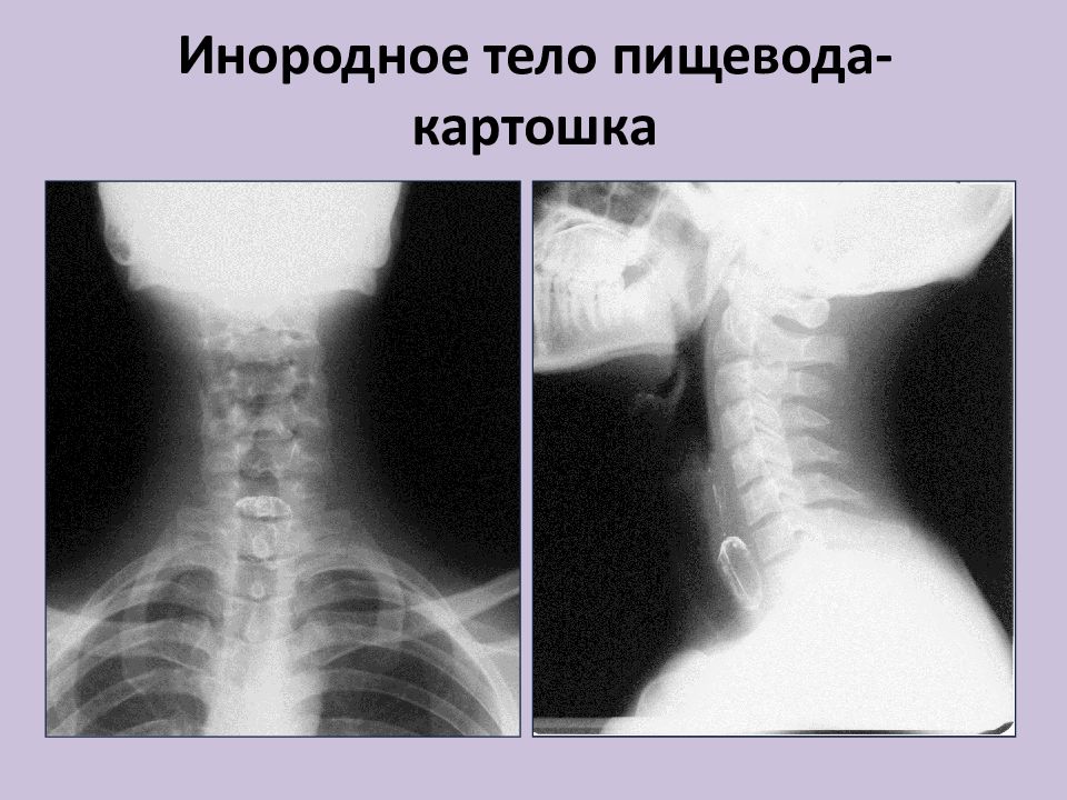 Инородное тело. Инородное тело пищевода рентген. Эзофагоскопия инородное тело пищевода. Инородные тела трахеи и пищевода. Инородные тела пищевода у детей.