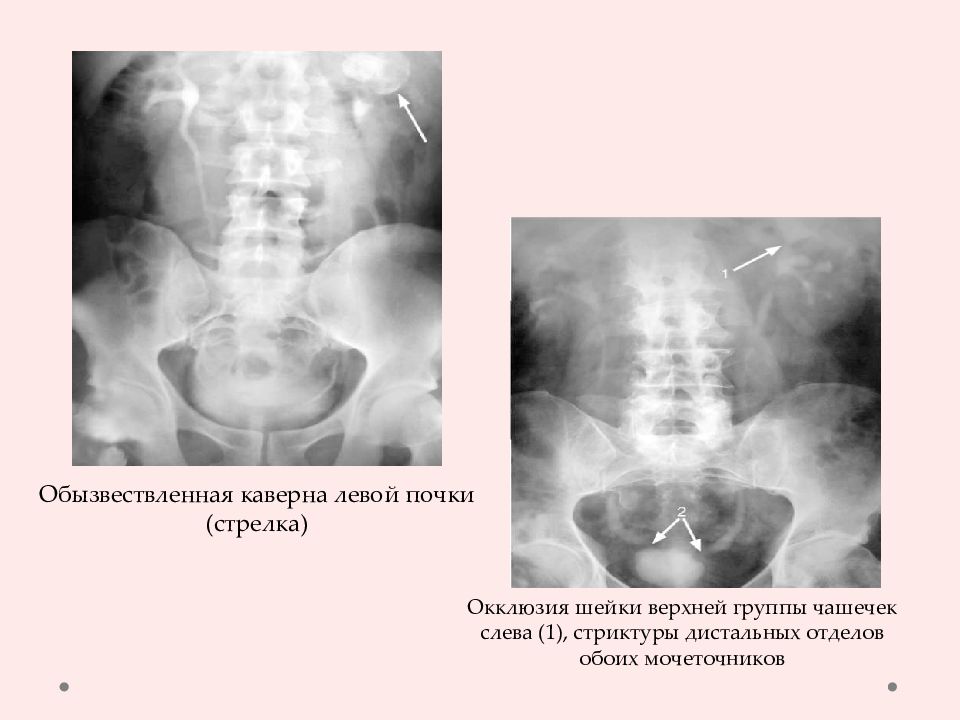 Туберкулез мочевыделительной системы презентация