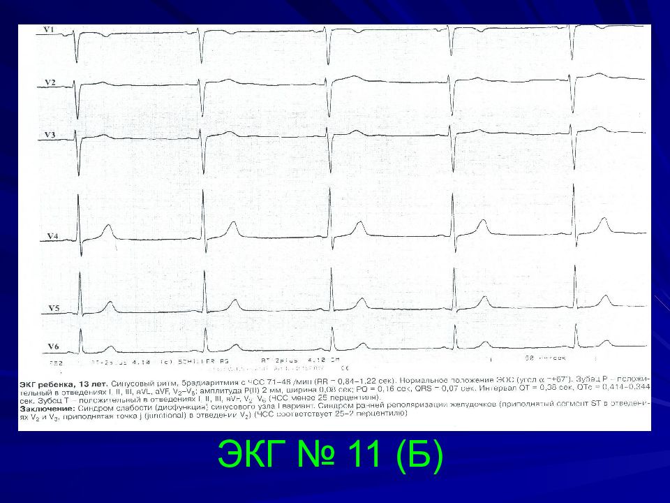 Брадиаритмия у ребенка. Синусовая брадиаритмия на ЭКГ. ЭКГ при синусовой брадиаритмии. Мерцательная брадиаритмия на ЭКГ. Синусовая брадиаритмия сердца что это такое.