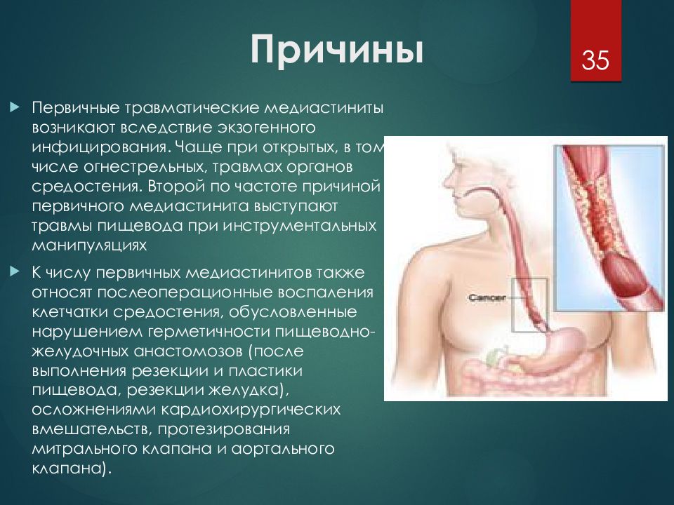 Одонтогенный медиастинит презентация