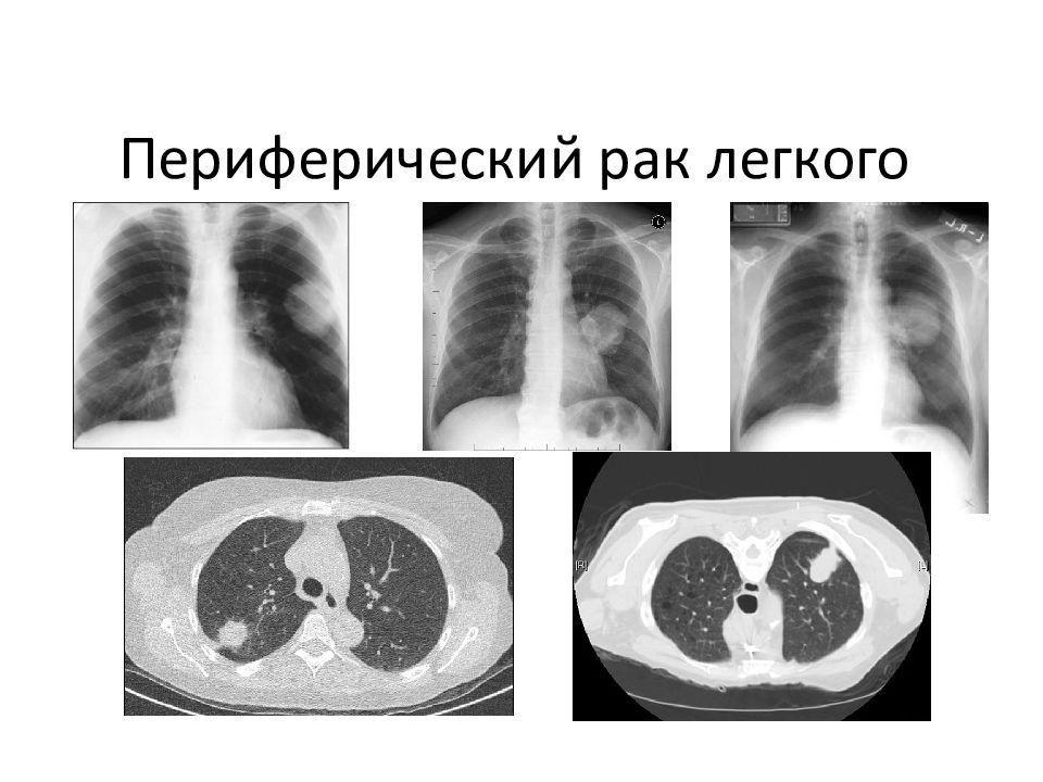 Центральный рак легкого картинки