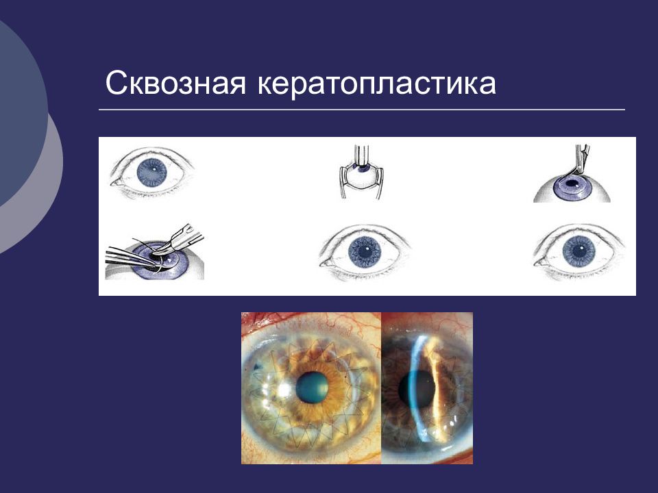 Кератопластика. Сквозная реконструктивная кератопластика. Техника сквозной кератопластики. Сквозная кератопластика после. Послойная кератопластика.