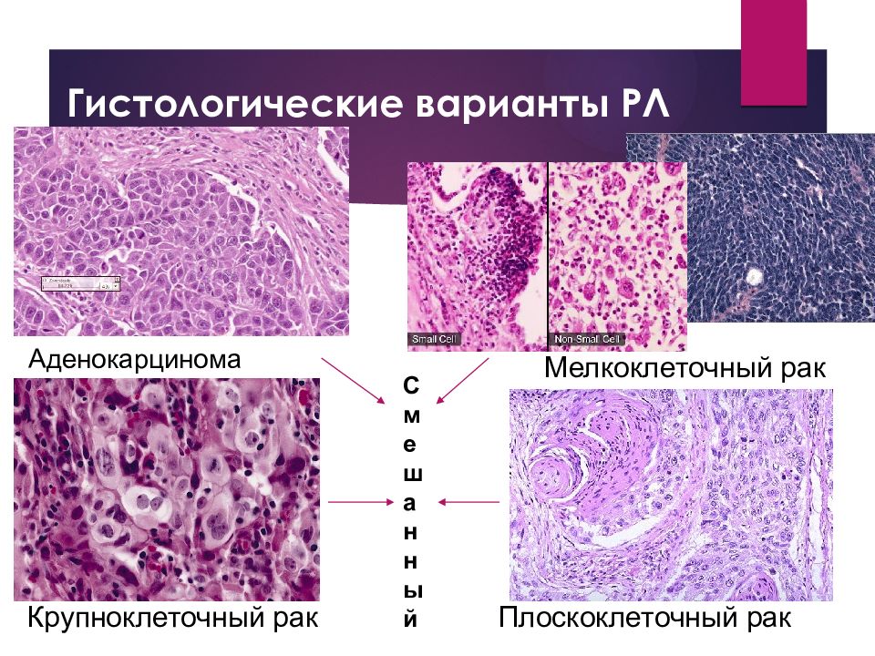 Строение опухоли картинка