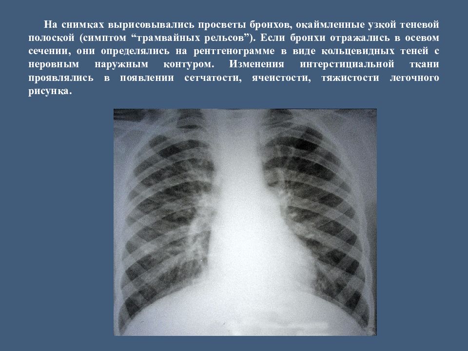 Лучевая диагностика хобл презентация