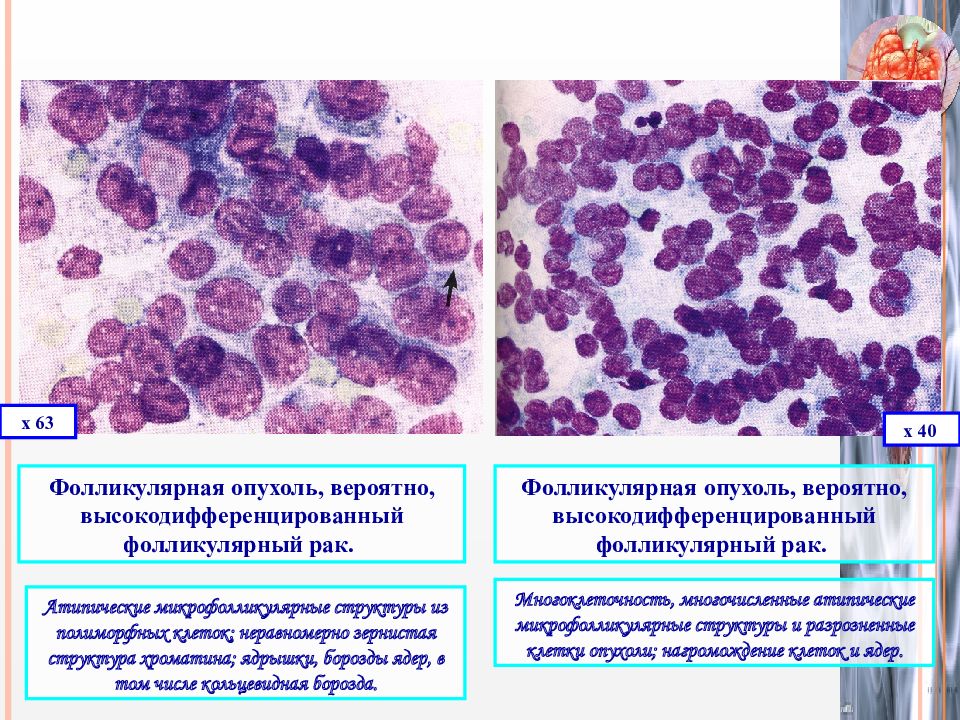 Цитологическая картина фолликулярной опухоли щитовидной железы что значит