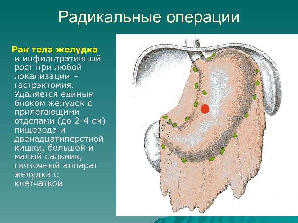 Рак желудка операции презентация