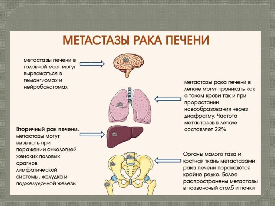Рак печени 4 стадии сколько живут. Степени поражения печени метастазы. Метатсатические опухоли печень. Вторичные (Метастатические) опухоли печени.