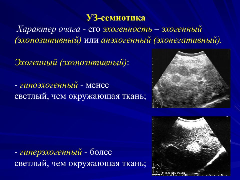 Расширенная полость матки с анэхогенным содержимым. Гиперэхогенные структуры. Анэхогенные структуры. Гипоэхогенная структура.