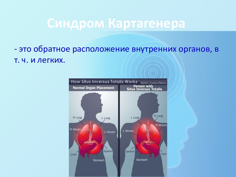Зеркальное расположение органов синдром